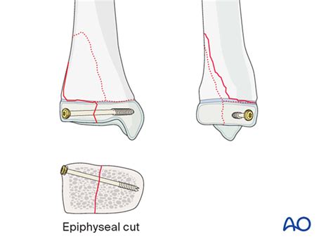 Open reduction; screw fixation for Complex epi-/metaphyseal fractures ...