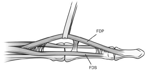 Fdp And Fds Tendons : FDS-5 variations. Muscle: A. Normal, B. Absent, C. Unusual, D ...