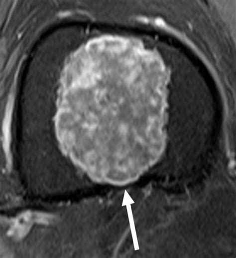 Chondrosarcoma Mri