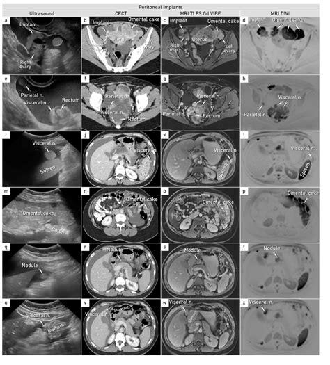 Diagnostics | Free Full-Text | Yolk Sac Tumor of the Omentum: A Case Report and Literature Review