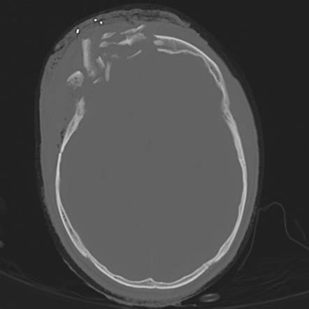 Head injury (massive) | Radiology Case | Radiopaedia.org