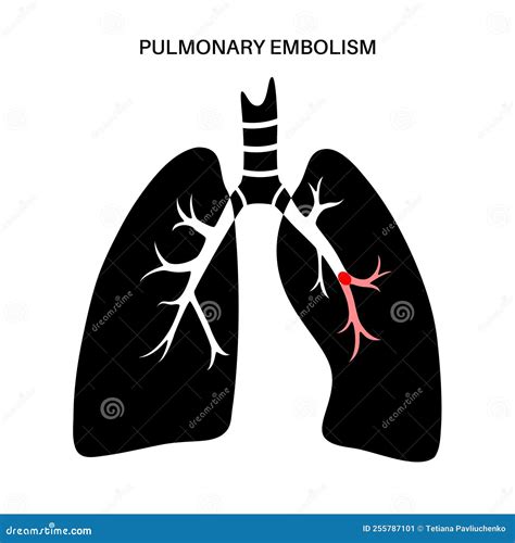 Pulmonary embolism disease stock vector. Illustration of breath - 255787101