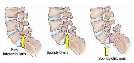 What is Spondylolisthesis? Causes, Symptoms, Diagnosis