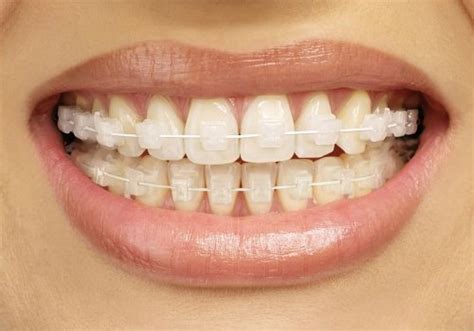 Cosmetic Braces – West Bluff Dental Care