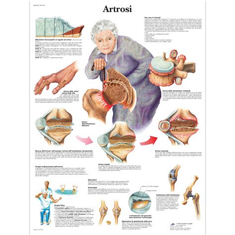 Artrosi - 4006899 - VR4123UU - Sistema Esquelético - 3B Scientific