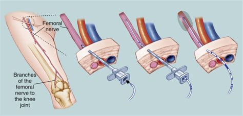 Continuous Peripheral Nerve Blocks | Anesthesia Key