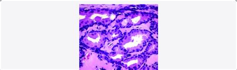 Ceruminous adenoma demonstrating glandular articulations with two... | Download Scientific Diagram