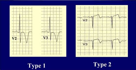 Wellens Syndrome Ecg Changes