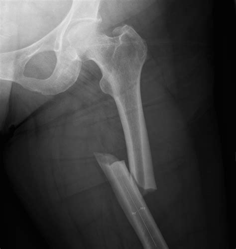 Bilateral Compound Femur Fracture - Foto Kolekcija