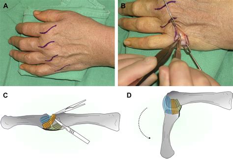 References in Management of the Stiff Finger - Clinics in Plastic Surgery