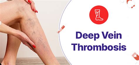 Treatment Options For Deep Vein Thrombosis: Medications, Surgery, And ...