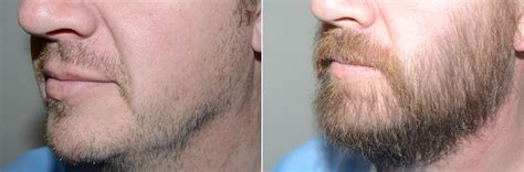 Facial Hair Transplant photos | Miami, FL | Patient123387