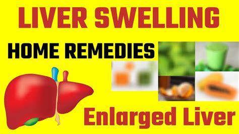 Liver Swelling Home Remedy | Enlarged Liver Treatment Home Remedy - YouTube