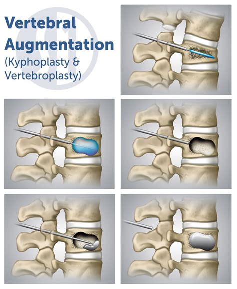 Kyphoplasty - Spine One | Denver Spine Pain Specialists