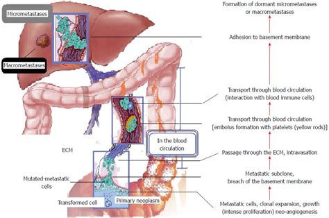 How Does Colon Cancer Metastasis To Liver - CancerWalls