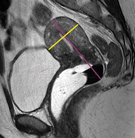 Update on MRI in Evaluation and Treatment of Endometrial Cancer ...