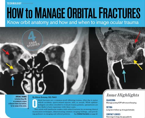 Orbital Floor Fracture Healing Time | Floor Roma