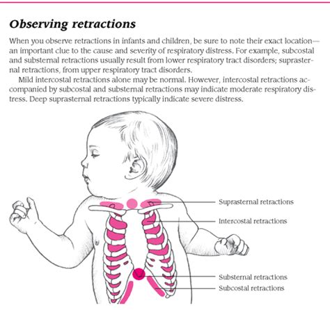 Chest wall retractions are more prominent and easily observed among ...