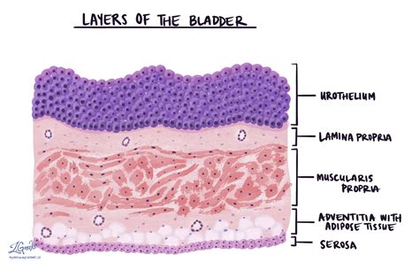 Urothelial papilloma | MyPathologyReport.ca