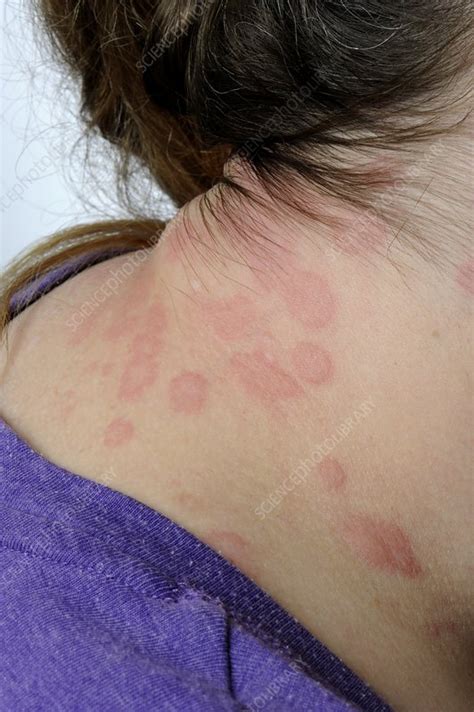 Urticaria on the neck - Stock Image - C011/7555 - Science Photo Library