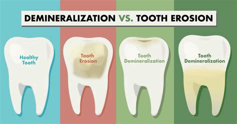 Understanding the Difference Between Demineralization and Tooth Erosion ...