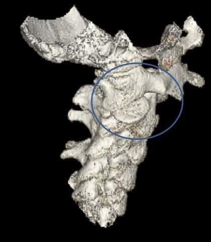 Atlantoaxial Instability