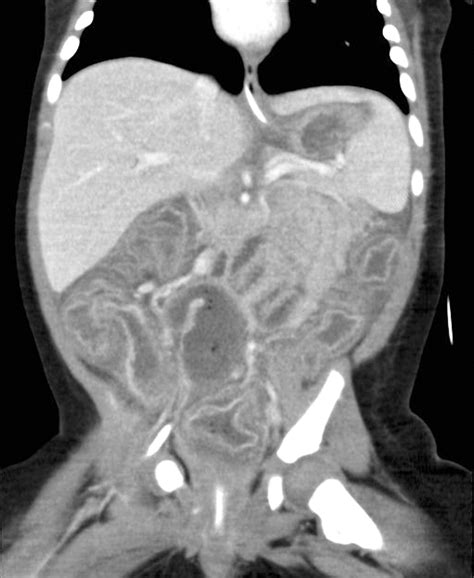 CT images of Hirschsprung’s associated enterocolitis: a rare finding | Archives of Disease in ...