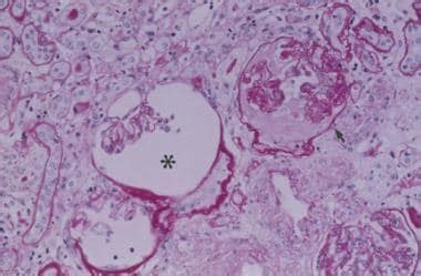 Nephrosclerosis: Background, Pathophysiology, Epidemiology