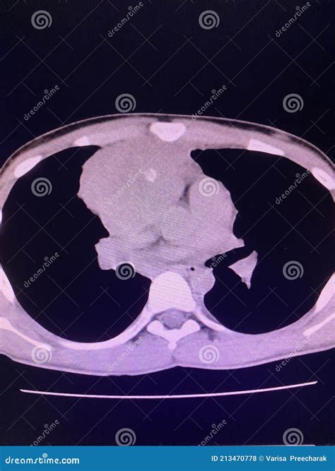 CT Scan Mass at Interior Mediastinum Stock Photo - Image of chronic, neoplasia: 213470778