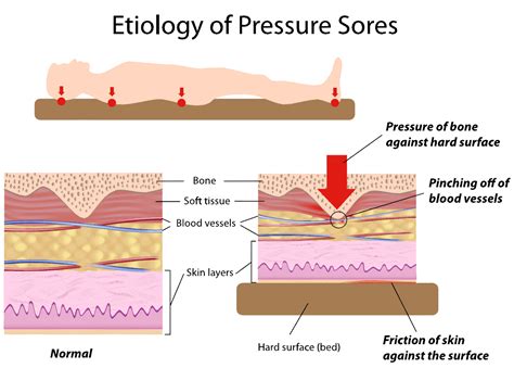 Bed Sores Should Never Happen - Pennsylvania Nursing Home Abuse Lawyers | L&A