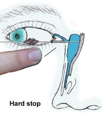 Lacrimal System Probing and Irrigation: Overview, Technique, Periprocedural Care