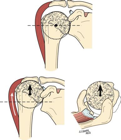 Glenohumeral Arthritis and Its Management | Thoracic Key