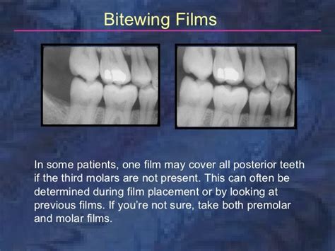 radiology-bitewing-technique