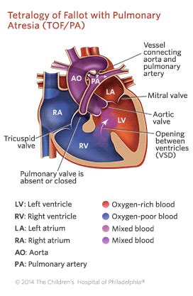 Pulmonary Atresia | Children's Hospital of Philadelphia