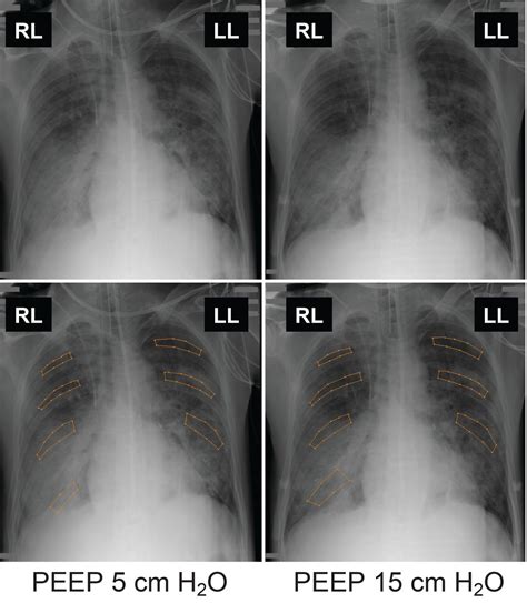 Ards Chest X Ray - lusomentepalavras