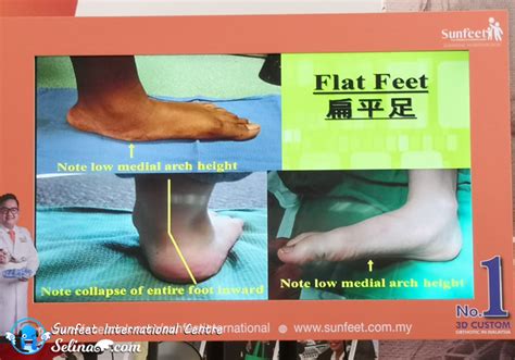 Sunfeet International Rehabilitation Centre - Foot Care, Orthotics and ...