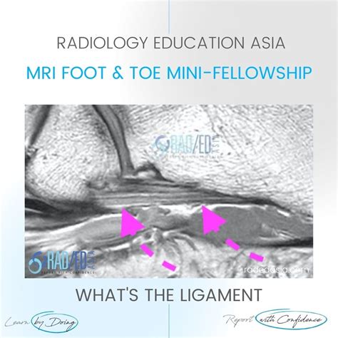 MRI PLANTAR LIGAMENT SHORT PLANTAR LIGAMENT ANKLE FOOT AND TOE (VIDEO) - Radedasia