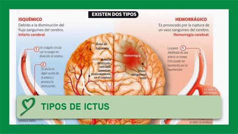 Tipos de ICTUS - YouTube