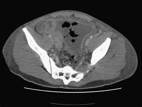 Large pelvic fluid collection with pockets of free intraperitoneal gas | Download Scientific Diagram