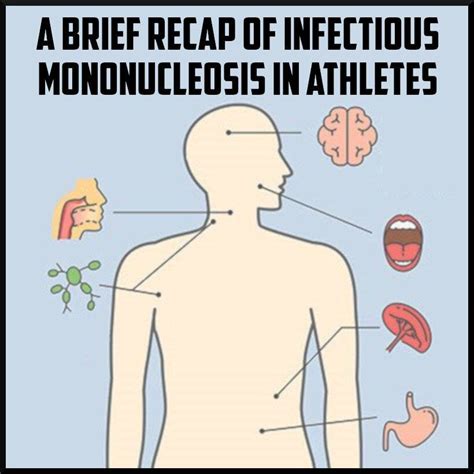 Mononucleosis - Acute Infectious Mononucleosis Pathogenesis And Clinical Findings Calgary Guide ...