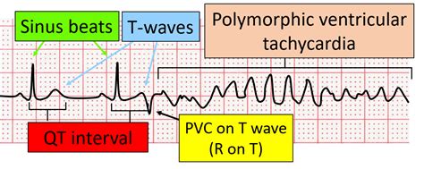 R on T Premature Ventricular Complexes (PVC) Simplified | ECGEDU.com