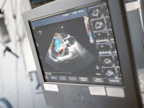 What is an echocardiogram? Uses, procedure, and results