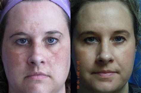 Laser Skin Rejuvenation Before & After Pictures Case 12 – Coeur d'Alene, ID & Spokane, WA – Dr ...