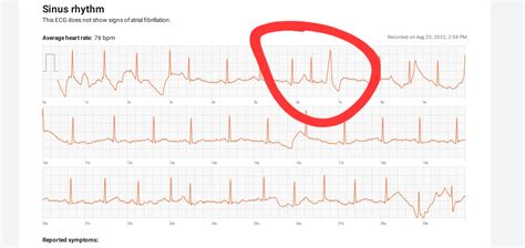 Is it possible for a PVC to immediately follow a PAC? : r/ECG