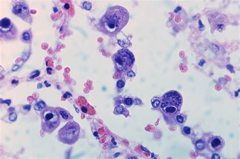 Cytomegalovirus infection | Basophilic nuclear inclusions wi… | Flickr