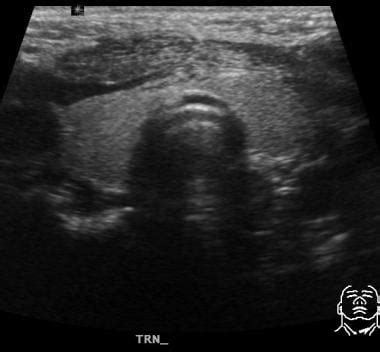 Thyroglossal Duct Cyst Ultrasound