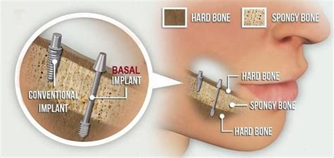 What are Bicortical dental implants or Basal implants | News | Dentagama