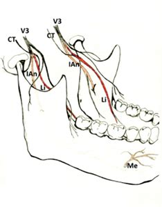 Lingual Nerve Injury: Surgical Anatomy and Management (2022)