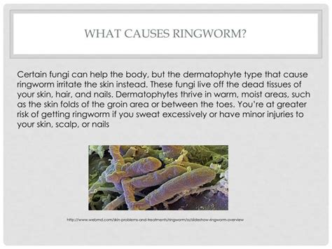 PPT - What Is Ringworm? PowerPoint Presentation - ID:3020046