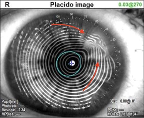 Salzmann’s Nodular Degeneration | Champlain Ophthalmology